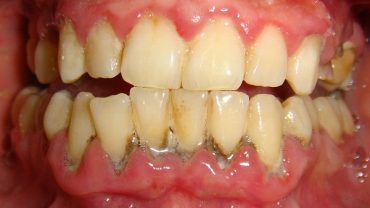 trị viêm răng cấp tính
